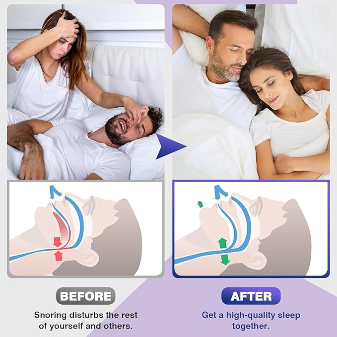 ANTI SNORING DEVICES